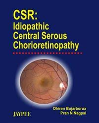 CSR Idiopathic Central Serous Chorioretinopathy 1st Edition 