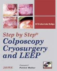 Step by Step Colposcopy, Cryosurgery & Leep with DVD-ROM