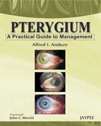 Pterygium - A Practical Guide to Management 1st Edition