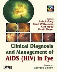 Clinical Diagnosis and Management of AIDS (HIV) in Eye with CD-ROM 1st Edition 