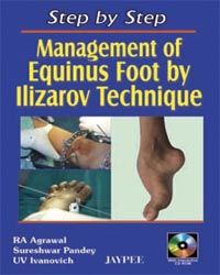 Step By Step Management of Equinus Foot By Ilizarov Technique with CD-ROM 1st Edition 