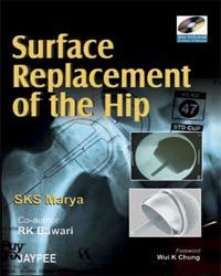 Surface Replacement of The Hip with DVD-ROM 1st Edition 