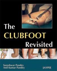 The Clubfoot Revisited