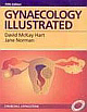 Gynaecology Illustrated , 5/e