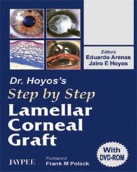 Dr.Hoyos` Step by Step Lamellar Graft with DVD Rom