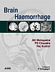 Brain Haemorrhage 1,e